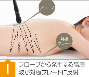 プローブから発生する高周波が対極板に反射